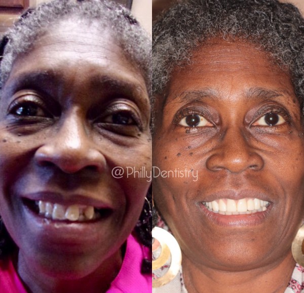 linda b. before and after