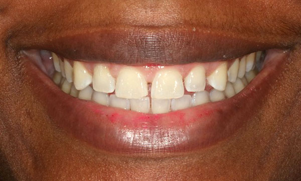 tiffani b before dental bonding