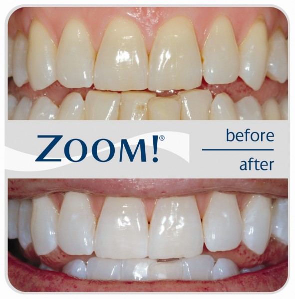 ZOOM-Before-After