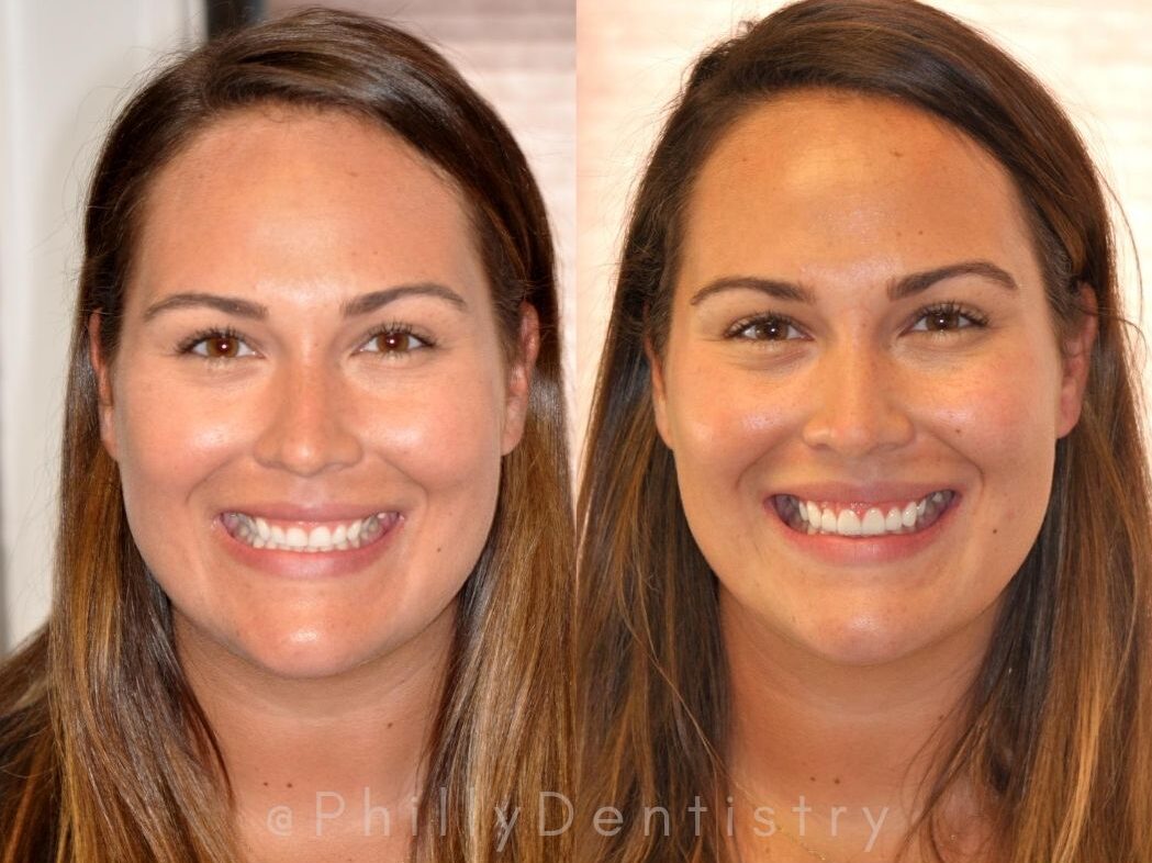 patient's before and after veneer photos.
