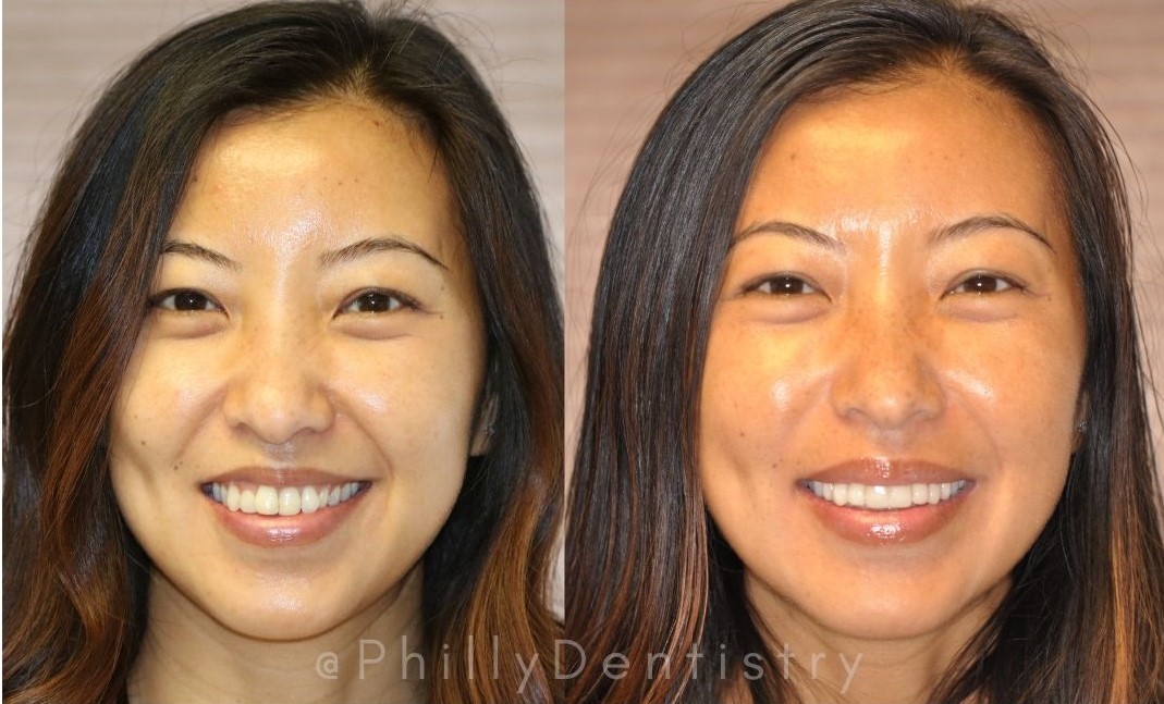 patient's before and after veneers photos