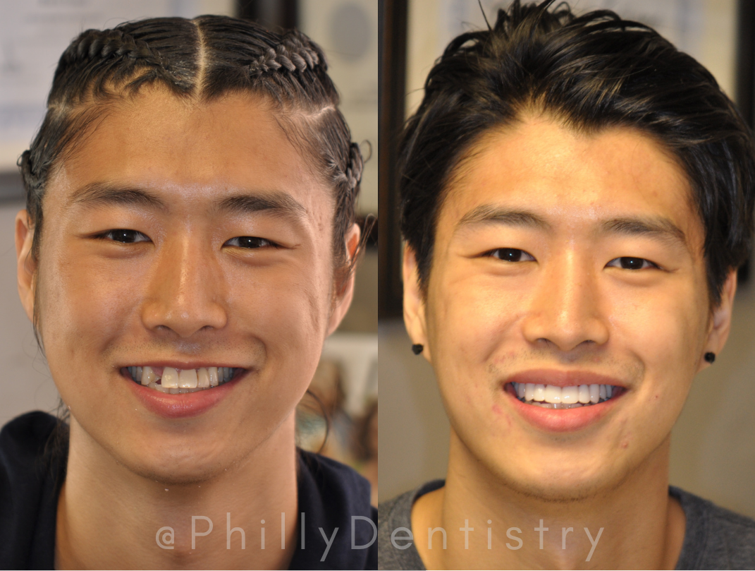 Patient's before and after veneer photos.
