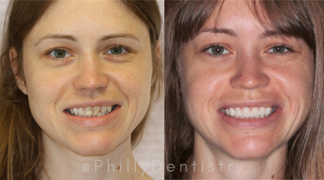 patient's before and after porcelain veneers