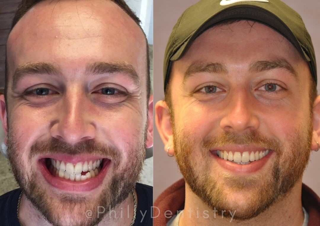a side by side photo of a patient showing off their before and after Invisalign treatment.
