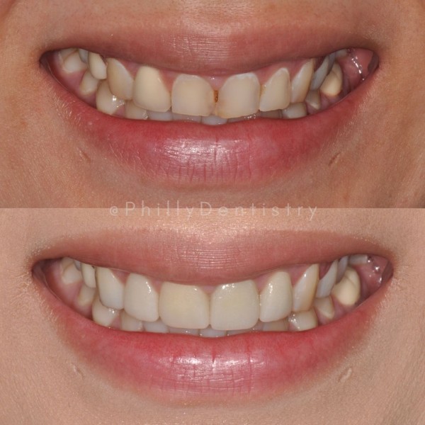 watermarked teeth1 USED