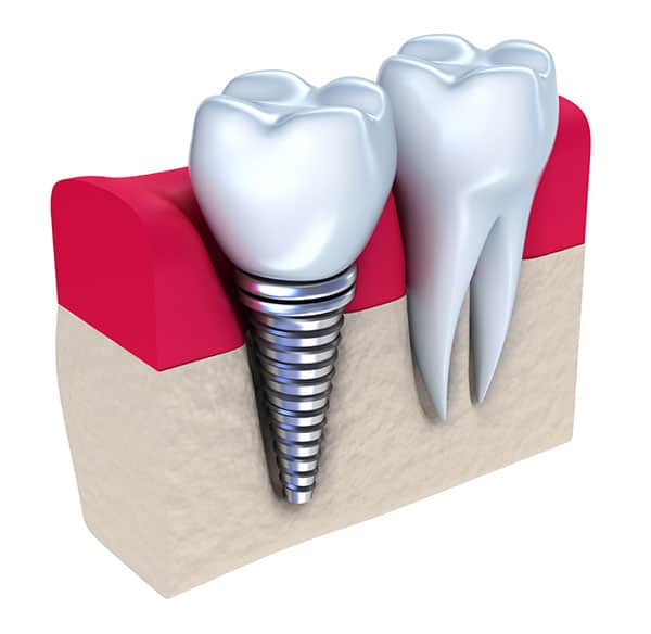 Dental Implants12