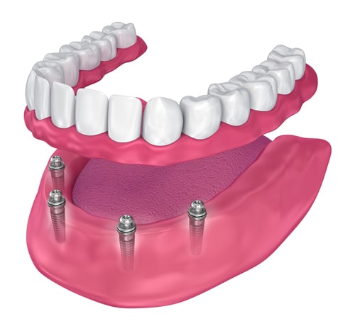 Overdenture,To,Be,Seated,On,Implants, ,Ball,Attachments.,3d