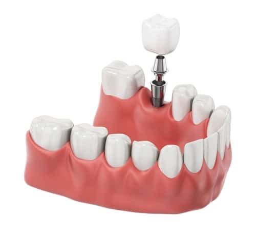 Tooth,Implant,Placed,On,Lower,Jaw,Isolated,On,White.,3d
