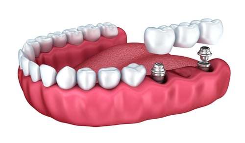 3d,Lower,Teeth,And,Dental,Implant,Isolated,On,White