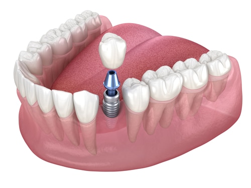 Premolar,Tooth,Recovery,With,Implant.,Medically,Accurate,3d,Illustration,Of
