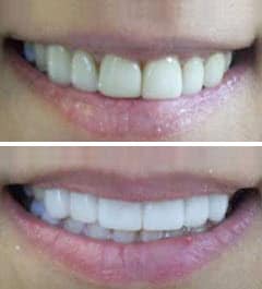 zoom teeth whitening 1